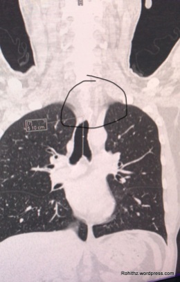 CT scan of the patient revealing tracheal stenosis